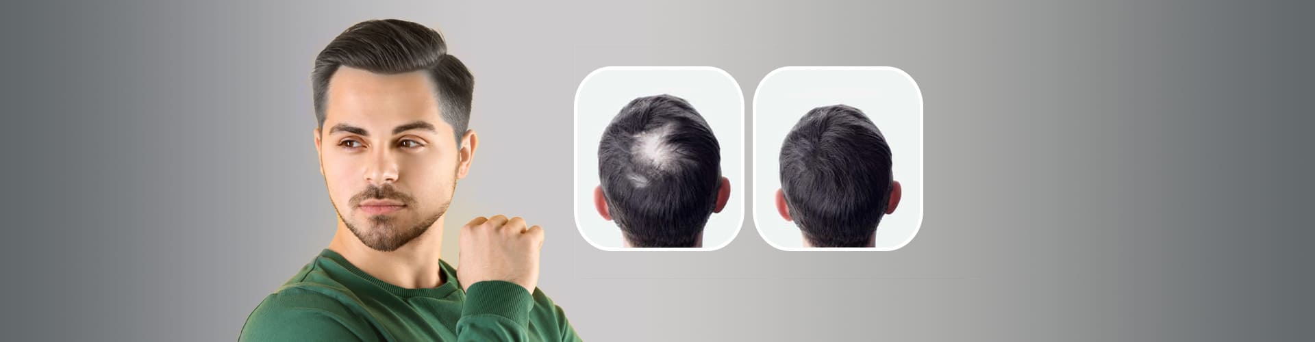 Hair Transplant Before and After result