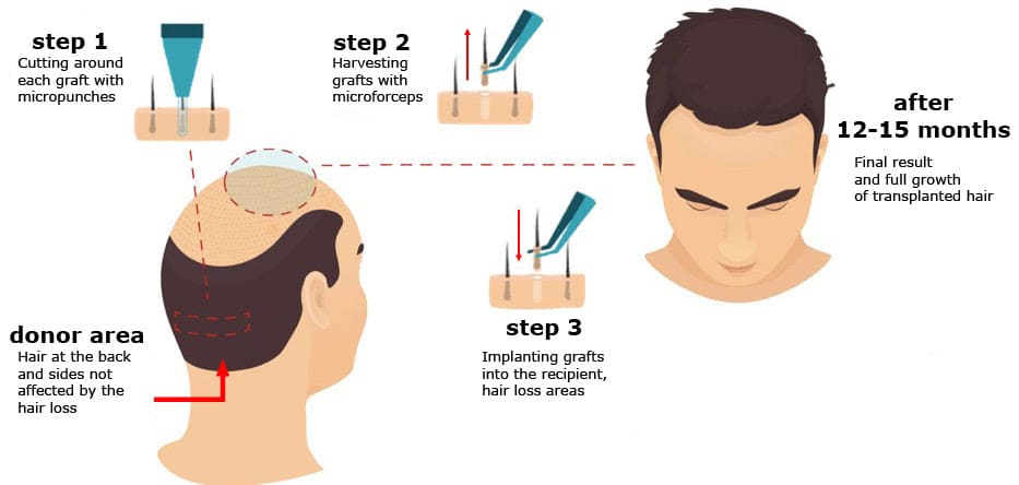 Hair Transplant Procedure