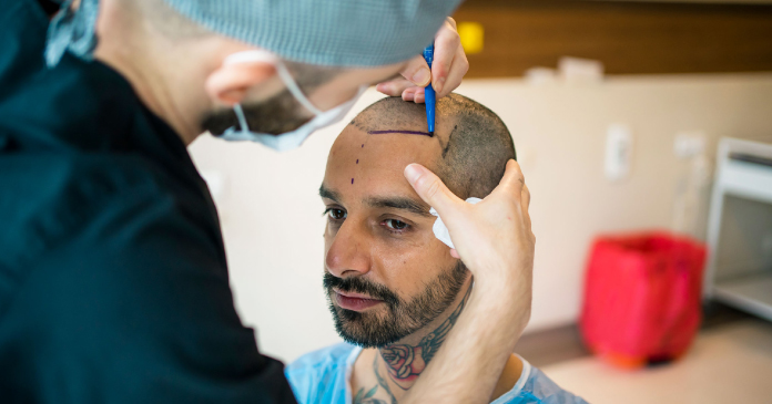 5 Key Factors That Influence The Success Of Hair Transplant