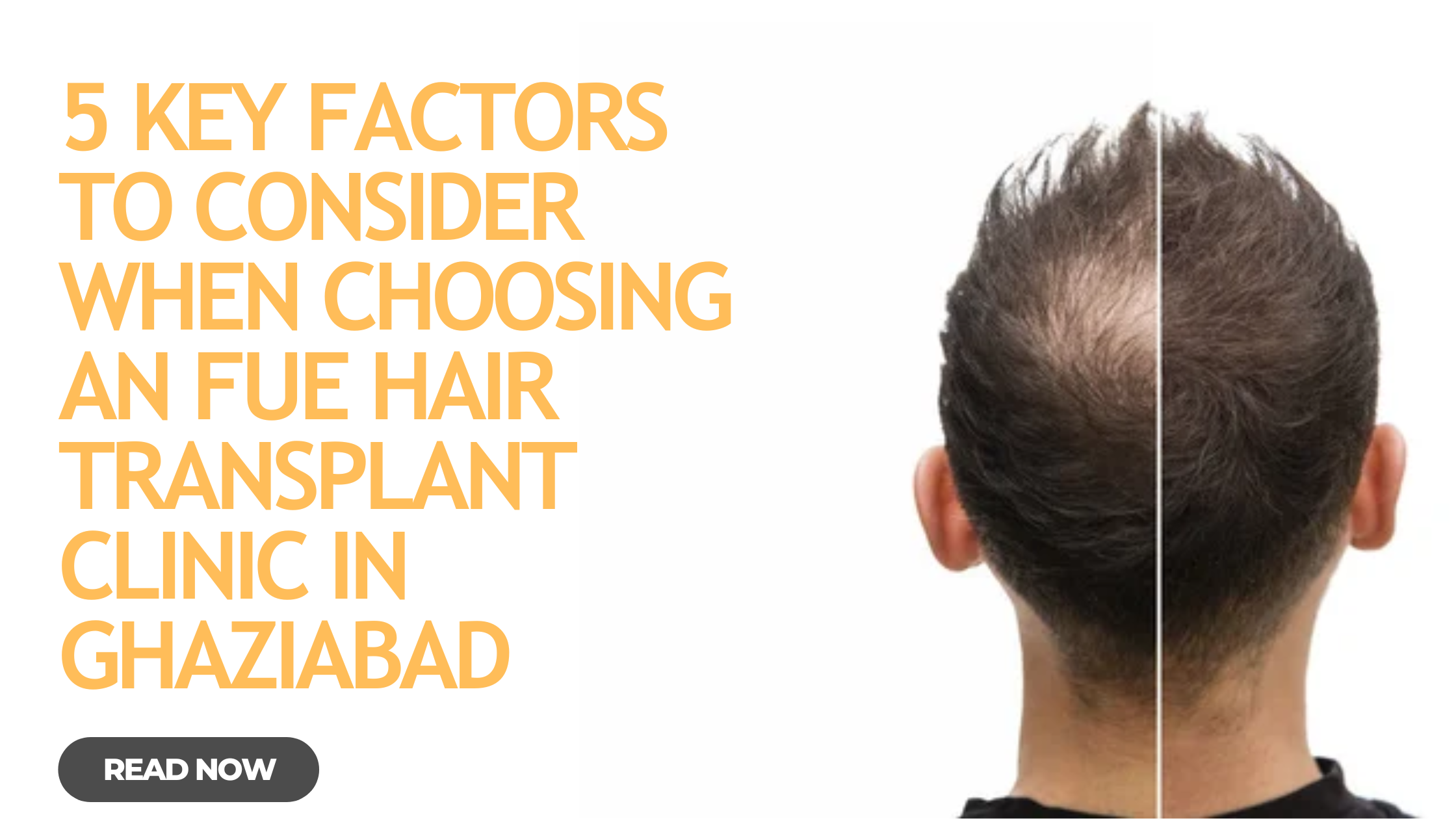 5 Key Factors to Consider When Choosing an FUE Hair Transplant Clinic in Ghaziabad