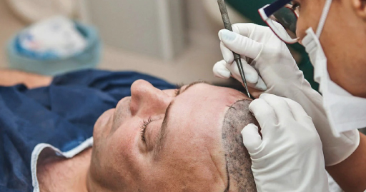 A SCIENTIFIC INVESTIGATION OF THE EFFECTIVENESS OF HAIR TRANSPLANTATION