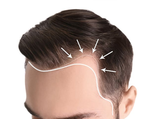 ADVANTAGES OF GETTING A HAIR RESTORATION TREATMENT