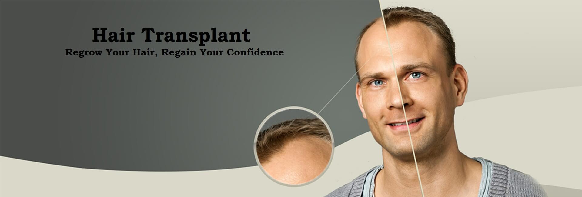 Hair Transplant: An Effective Hair Loss Treatment