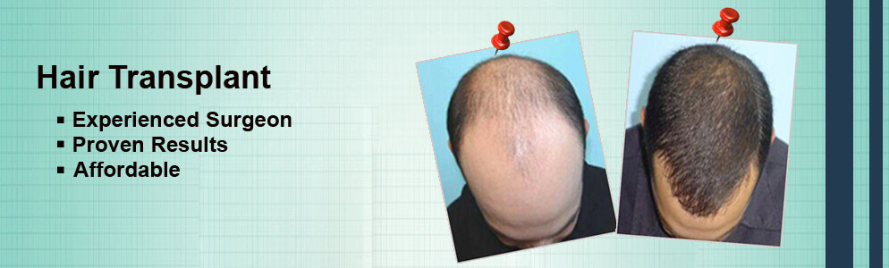 How to choose the Right Hair Transplant Doctor