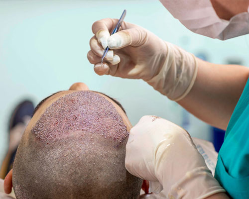 Advantages of Getting a Hair Transplant