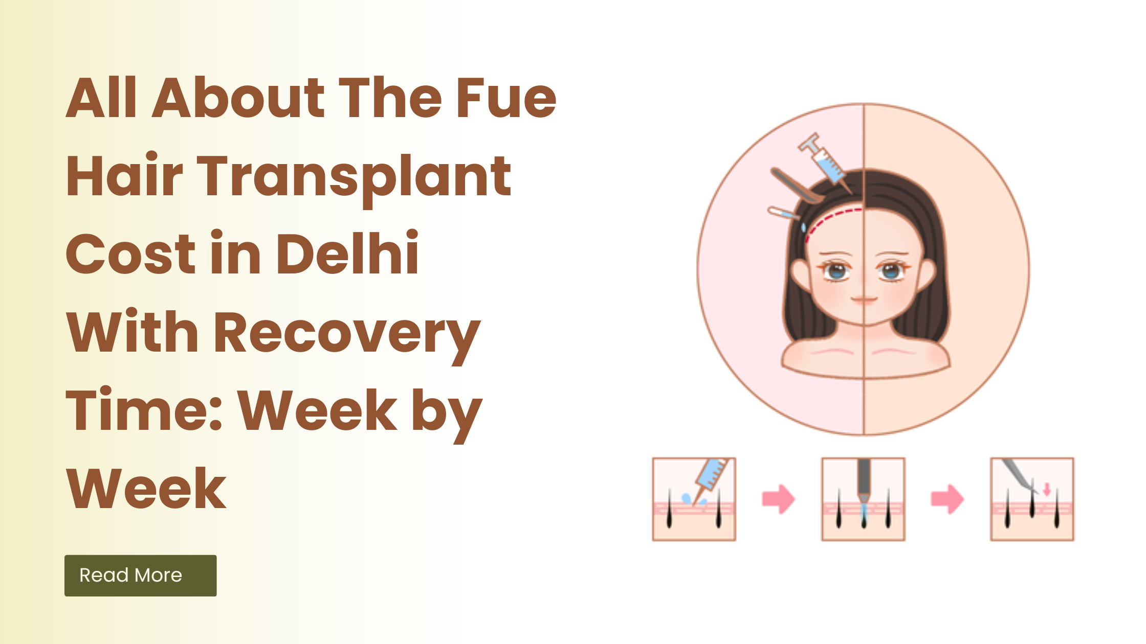 All About The Fue Hair Transplant Cost in Delhi With Recovery Time Week by Week