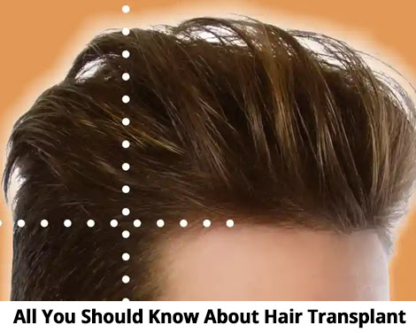 All You Should Know About Hair Transplant
