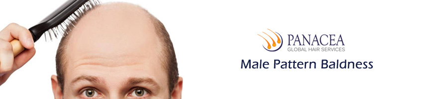 Causes of Male Pattern Baldness