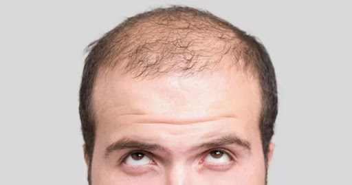 DELAY MALE PATTERN BALDNESS WITH THE BEST ALTERNATIVE TREATMENT MESOTHERAPY