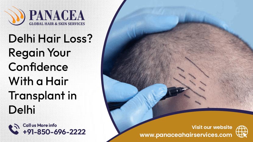 Delhi Hair Loss Regain Your Confidence with a Hair Transplant in Delhi