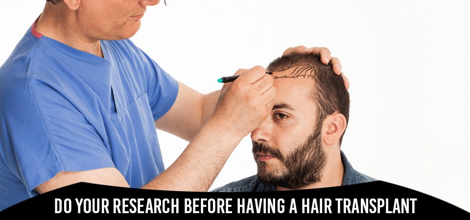 Do your research before having a hair transplant