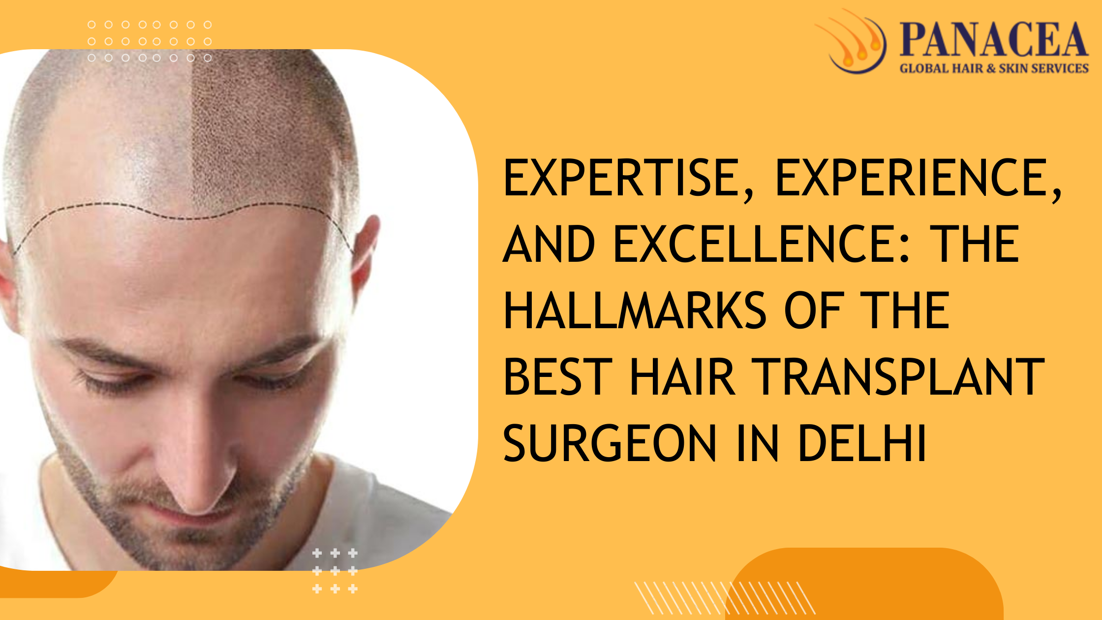 Experience The Hallmarks of the Best Hair Transplant Surgeon in Delhi