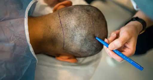 FROM COST TO METHODS ALL YOU NEED TO KNOW ABOUT HAIR TRANSPLANT IN INDIA