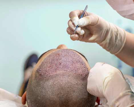 FUE Hair Transplant Benefits Precautions And Risks