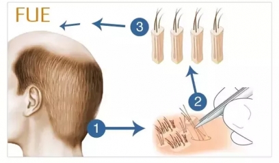 FUE and FUT style Hair Transplants Clinic in Delhi