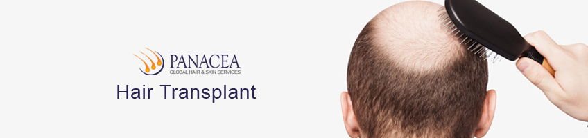 Facts You Need to Know About Hair Transplant