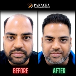 Leading FUE Hair Transplant Mumbai, India - Dr Malay Mehta
