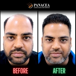 GET A COMPLETE IDEA OF HAIR TRANSPLANT COST IN DELHI