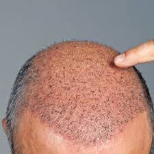 HAIR LOSS AND HAIR FALL TREATMENT