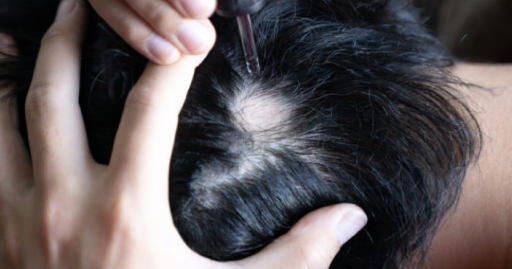 HAIR TRANSPLANT SURGERY NEGATIVE CONSEQUENCES AND POTENTIAL PROBLEMS