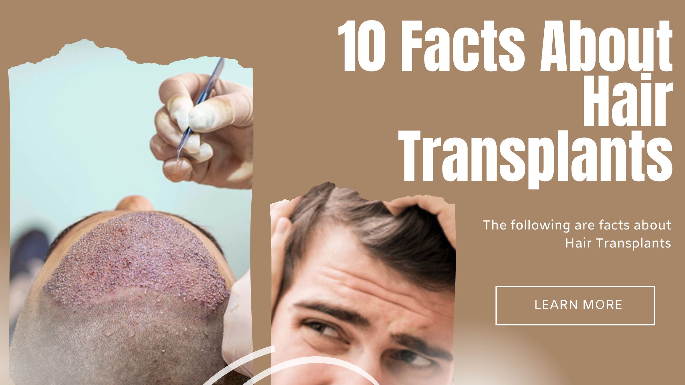 HERE ARE TEN KEY FACTS ABOUT HAIR TRANSPLANTS