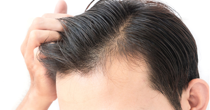 HOW PANACEA PERFORMS HAIR TRANSPLANT IN DELHI AND THE COSTS INVOLVED