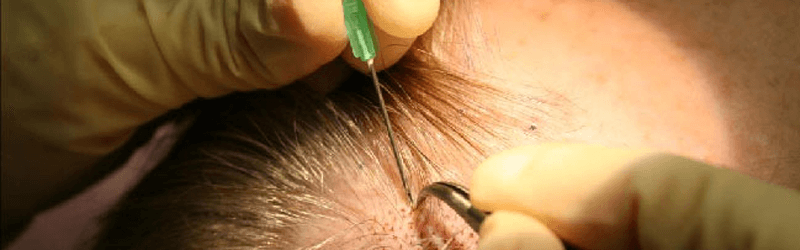 Hair Loss Treatment For Women