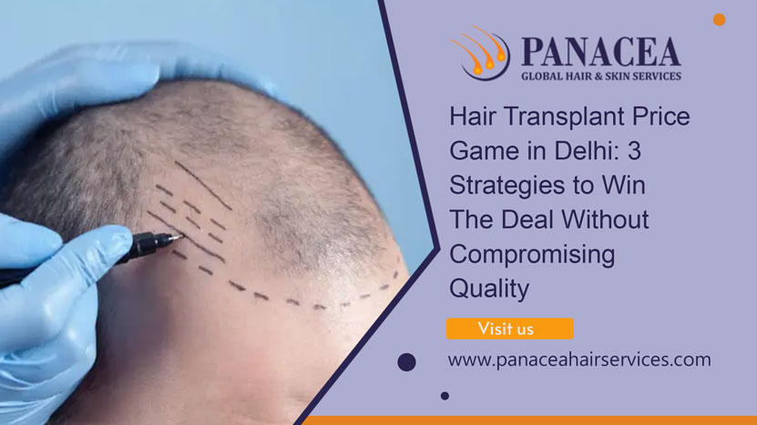 Hair Transplant Price Game in Delhi: 3 Strategies to Win the Deal