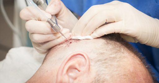 Hair Transplant Problems What Professionals Recommend When A Hair Transplant Goes Wrong
