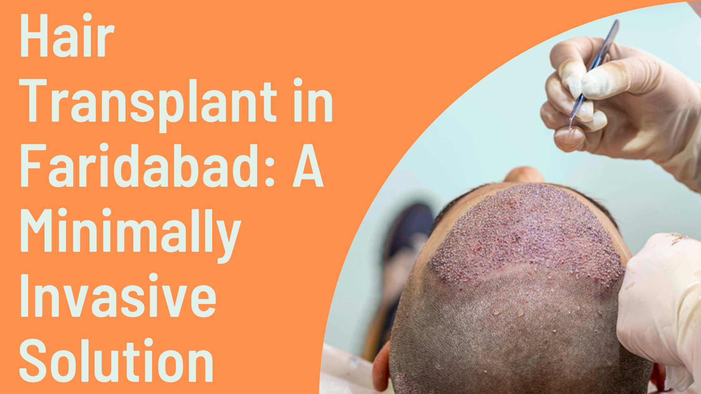 Hair Transplant in Faridabad A Minimally Invasive Solution