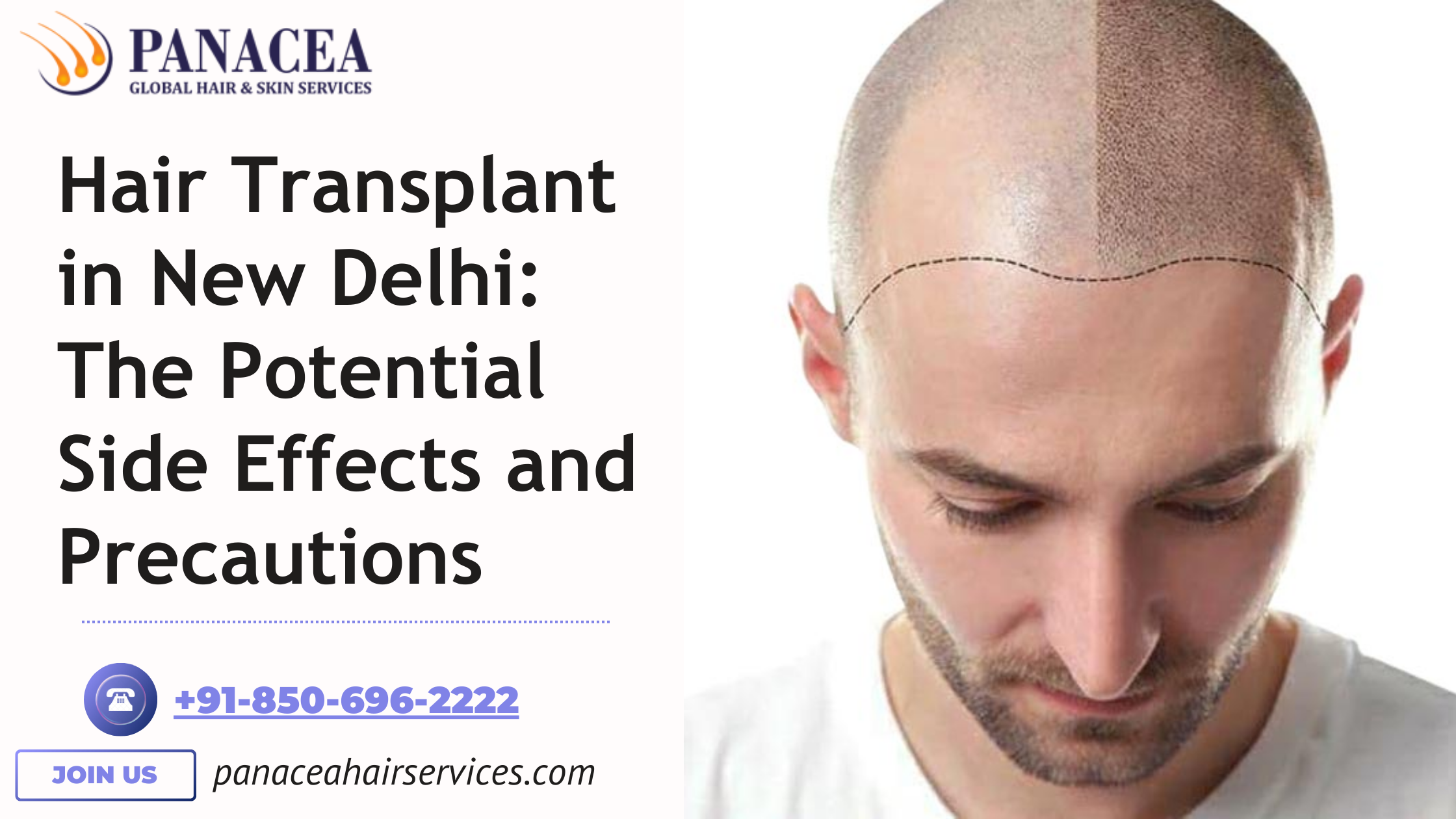 Hair Transplant in New Delhi The Potential Side Effects and Precautions