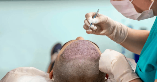 Hair Transplantation Benefits for Combating Severe Baldness