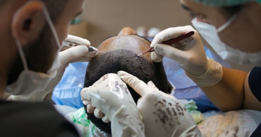 Hair Transplantation Or Prosthetic Hair Is There A Clear Winner