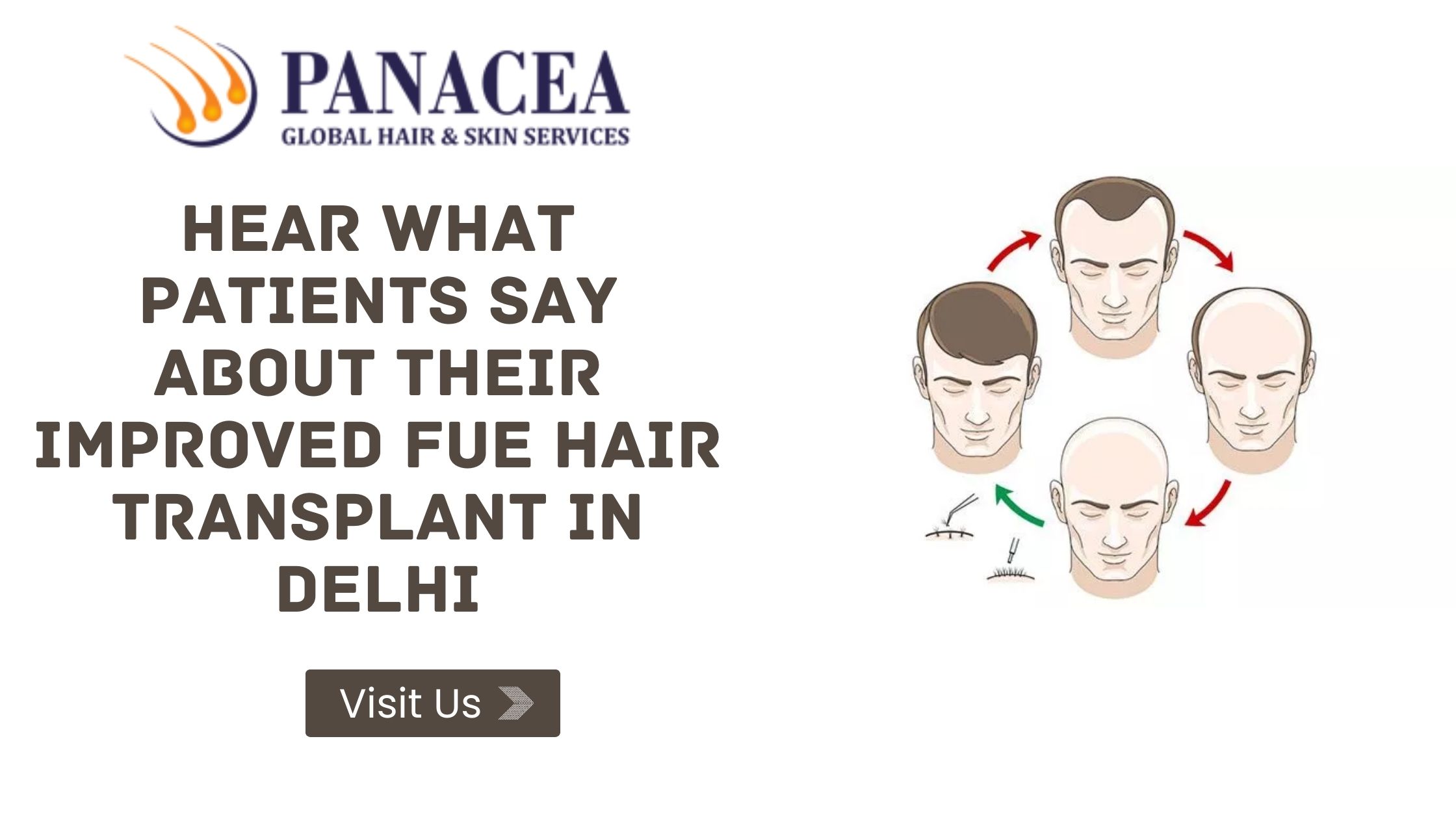 Hear What Patients Say About Their Improved FUE Hair Transplant in Delhi