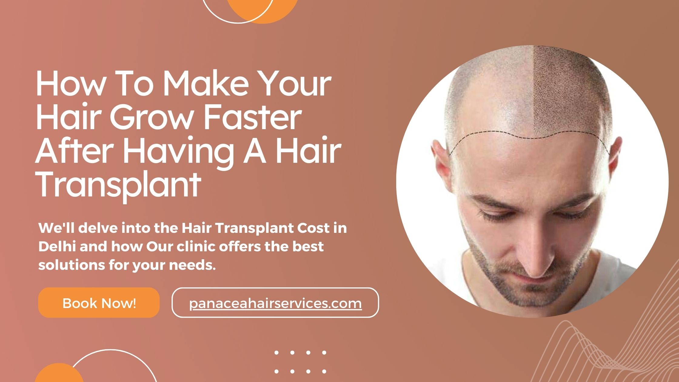 How To Make Your Hair Grow Faster After Having A Hair Transplant