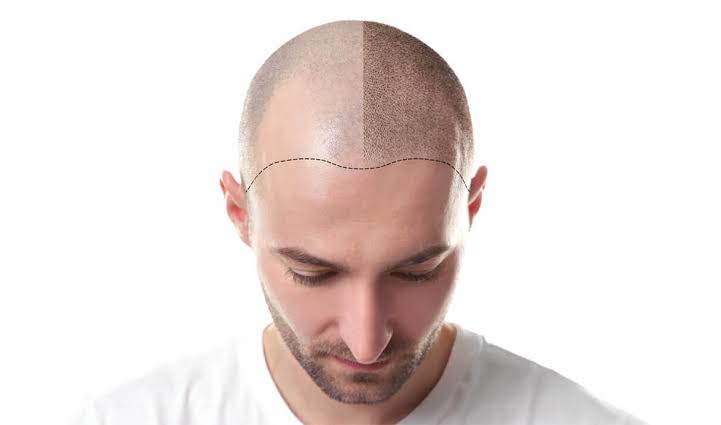 How a hair loss treatment can help you in battling baldness