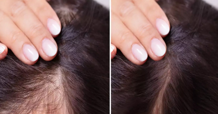 How to Achieve Natural-Looking High-Density Hair with a Hair Transplant