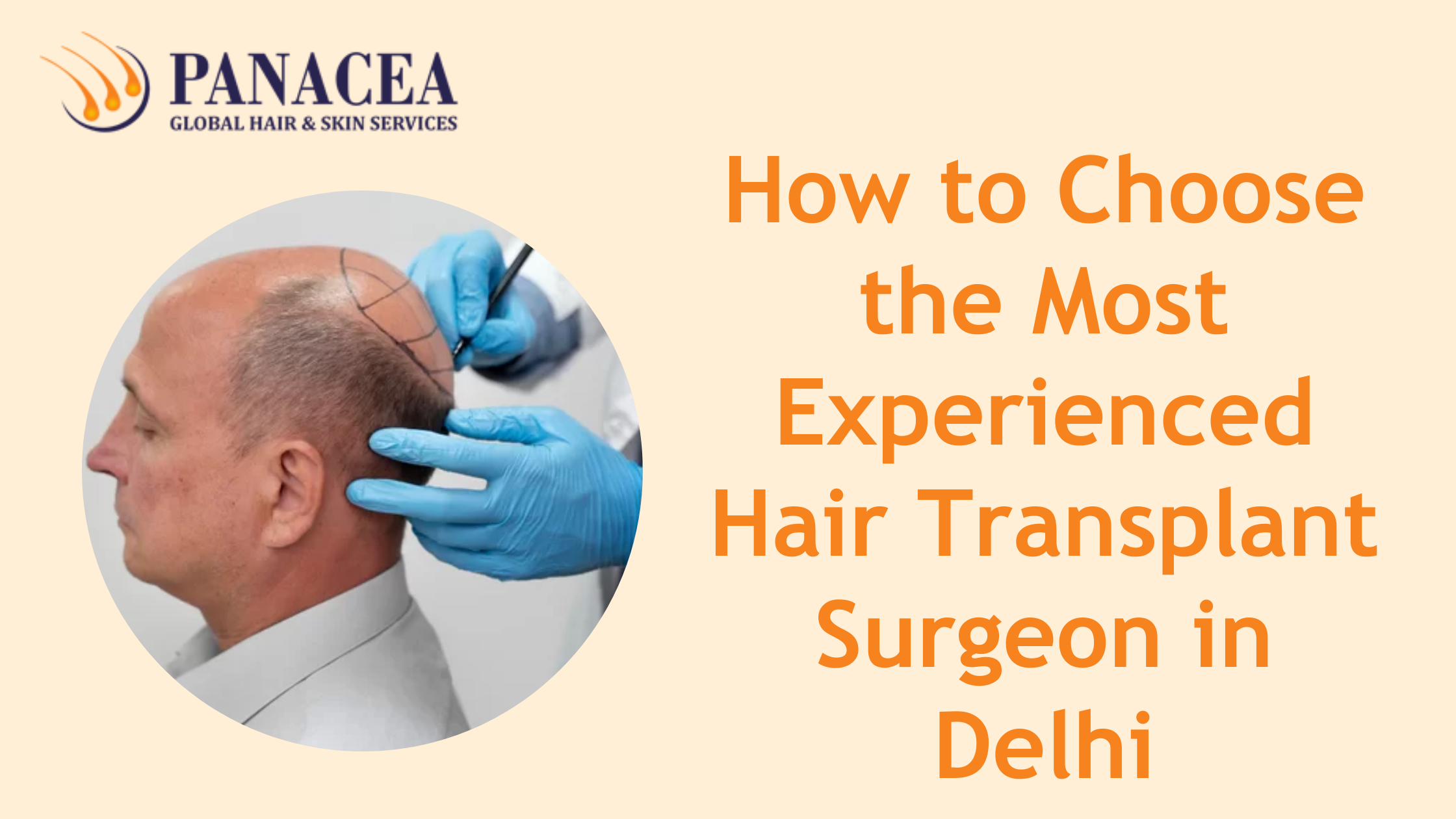 How to Choose the Most Experienced Hair Transplant Surgeon in Delhi