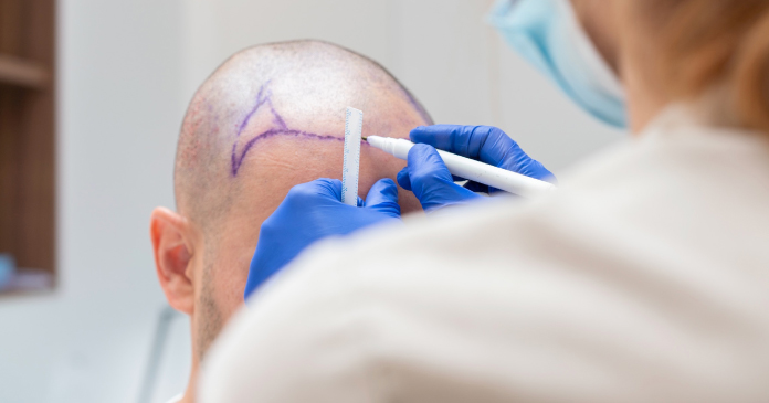 How to get the hair you have always wanted with hair transplantation