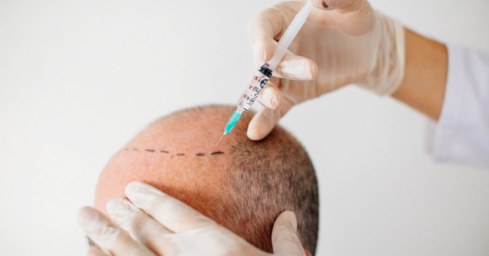 Is Hair Transplant A Safe Method A Comprehensive Guide