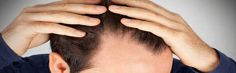 Is hair transplant right solution for your problem