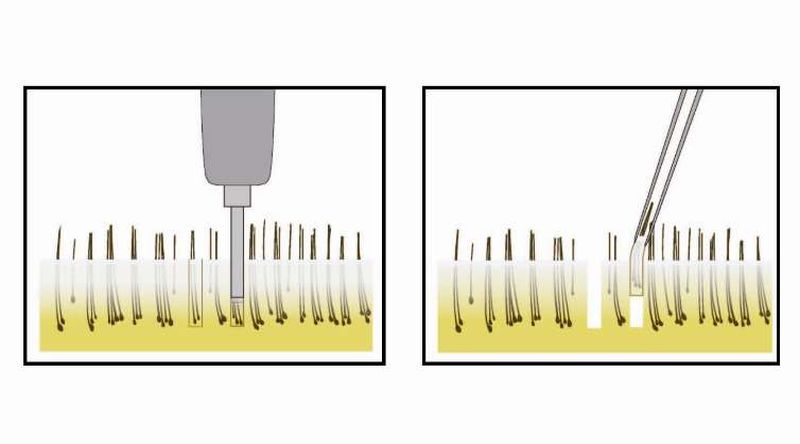 Know All About FUE Hair Transplant