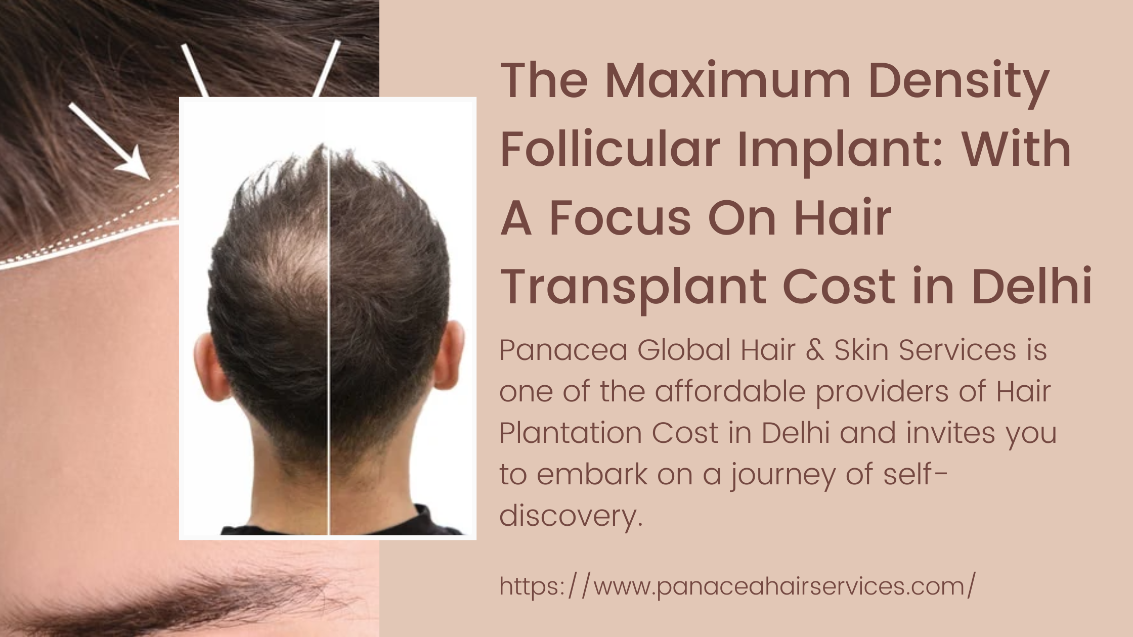 The Maximum Density Follicular Implant With A Focus On Hair Transplant Cost in Delhi