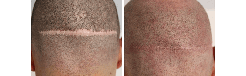 Micro mini grafts in a hair transplant