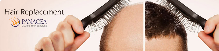 Modern Hair Replacement Methods for Treating Baldness