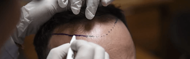 Modern hair transplant techniques have made it way easier than ever