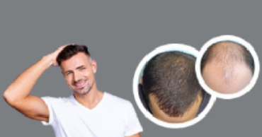 REGAIN YOUR CONFIDENCE BY GETTING A TREATMENT DONE FROM BEST HAIR TRANSPLANT CLINIC