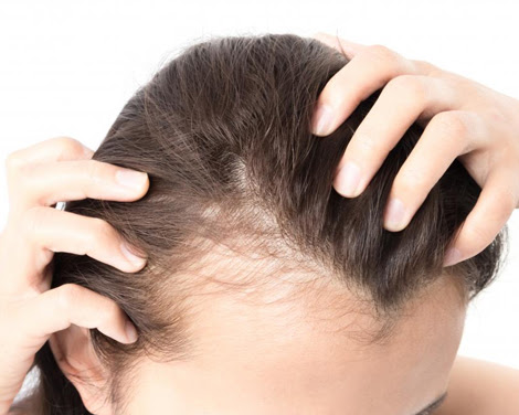 Reasons and Stages of Female Pattern Baldness
