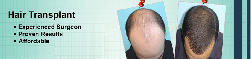 Restore Your Hairline With The Best Hair Transplant Surgeon