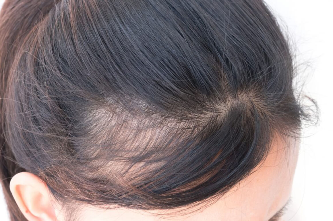SYMPTOMS AND EFFECTS OF PCOD ON HAIR AND BODY